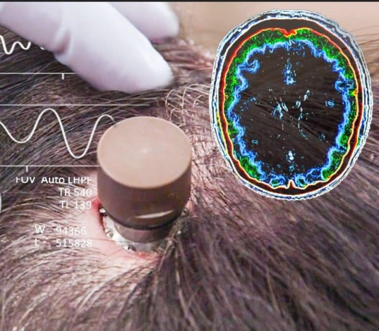 Primul om cu cip cerebral poate controla un mouse cu gândul