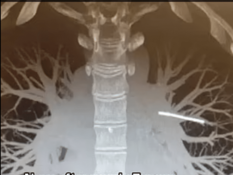 Medicii, în alertă, după ce implantul contraceptiv a ajuns în plămânii unii femei; poate muri, dacă e îndepărtat