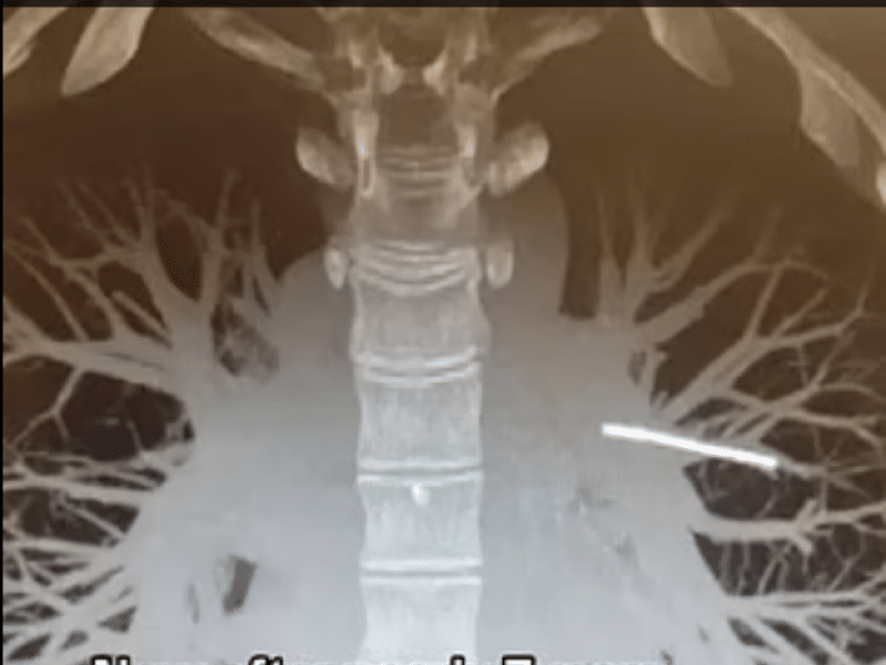 Medicii, în alertă, după ce implantul contraceptiv a ajuns în plămânii unii femei; poate muri, dacă e îndepărtat