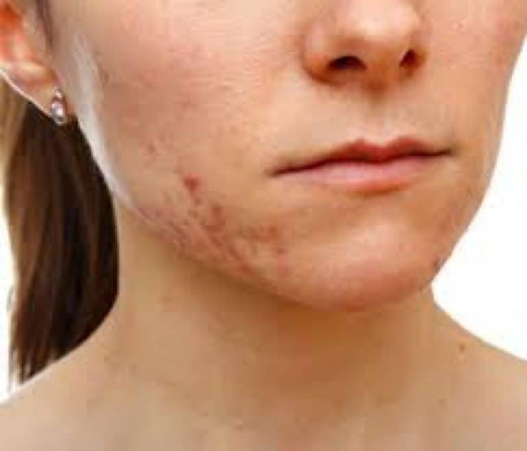 Afectiunile pielii sunt expresii cutanate ale unor boli psihice