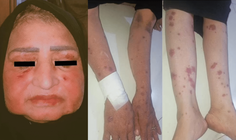 solzi de șarpe pe față și secreții din ochi